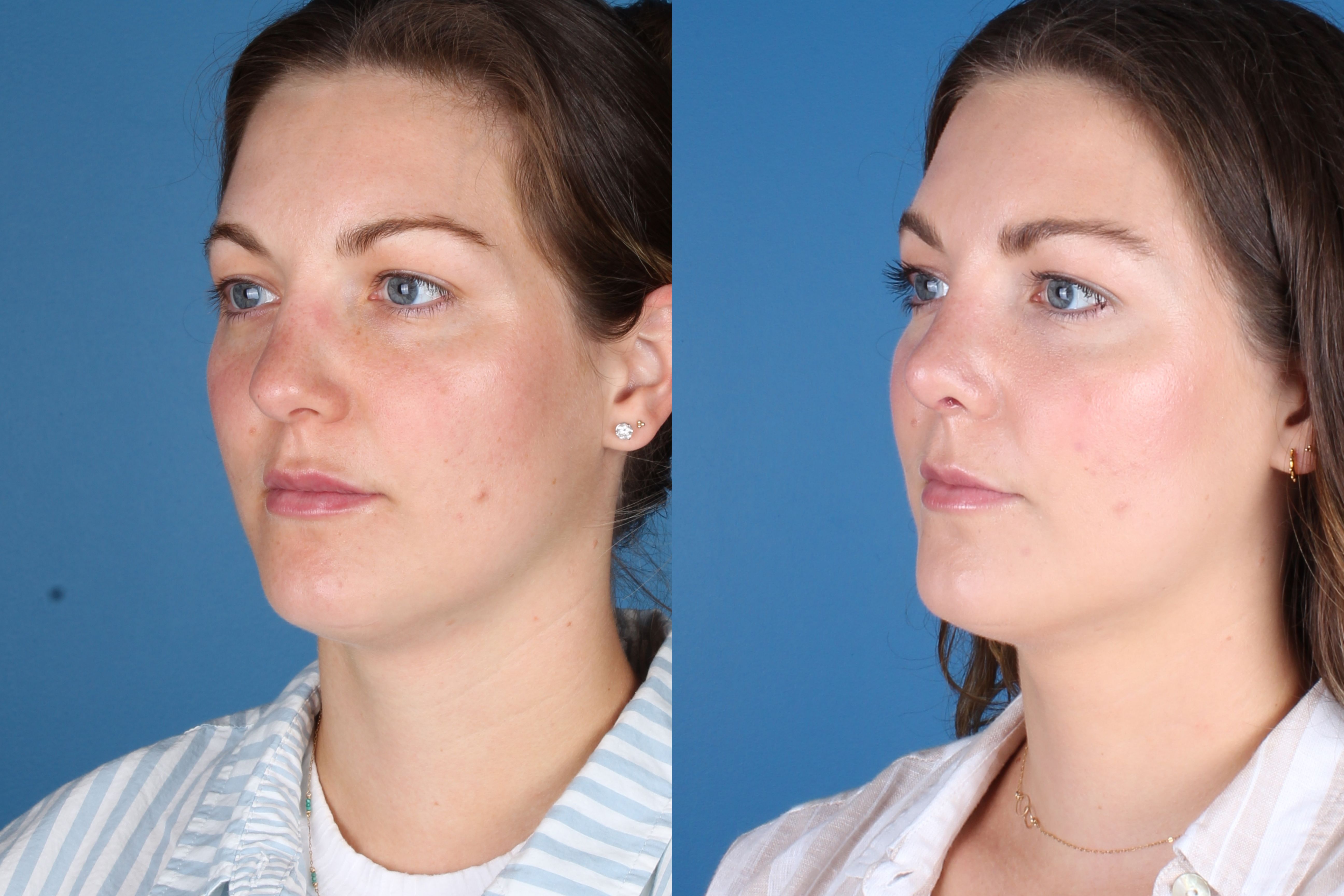 Denver Rhinoplasty Before And Afters Raval Facial Aesthetics